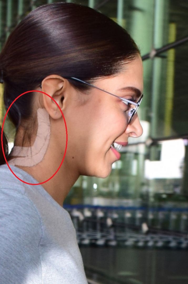 deepika padukone neck surgery3